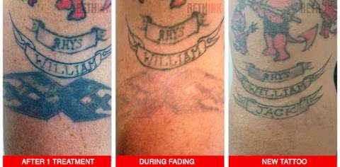 Photo: Rethink Laser Tattoo Removal